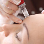 Meso Therapy